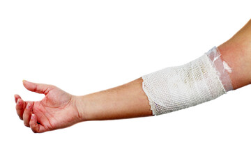 Phlebitis on hand isolated on a white.Vishnevsky ointment.Bandage