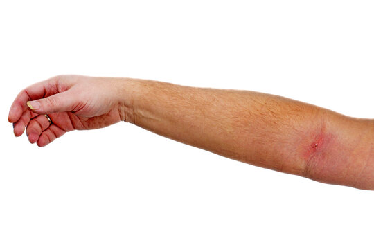Phlebitis on hand isolated on a white
