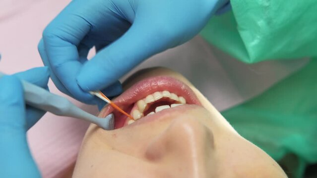 Close up video of dentist cleaning teeth in clinic with silicone stick, toothpick.