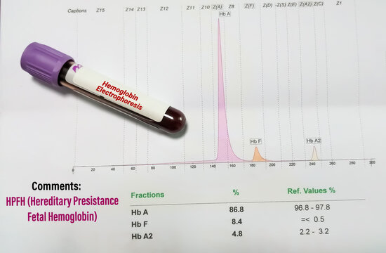 Hereditary Persistence Of Fetal Hemoglobin (HPFH). Hemoglobin Electrophoresis.