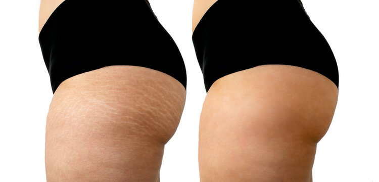 Image compare before and after Woman legs and buttocks with stretch marks removal treatment isolated on white background.