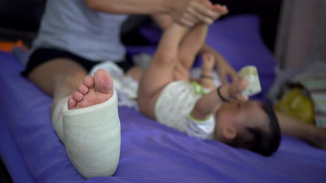 Close up broken leg with plaster bandage. Motherhood concept change diaper of child