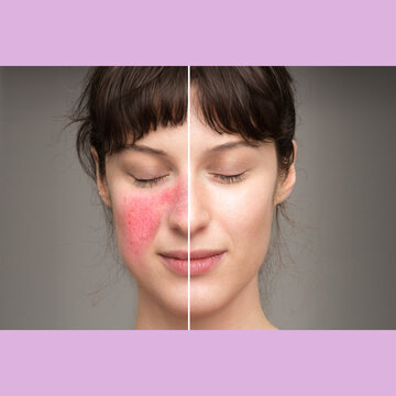 signs and symptoms of rosacea: natural cures in the treatment of skin disorders