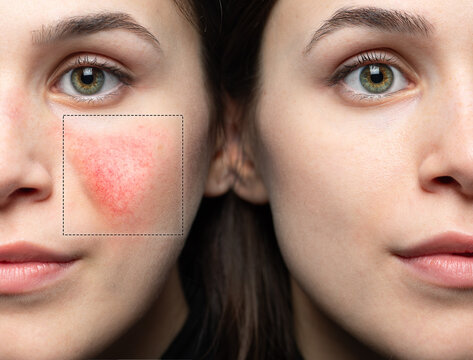 Rosacea before and after laser treatment.