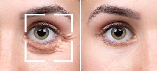 Woman eye before and after crow's feet and dark circles removal