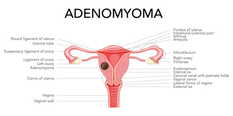 Adenomyoma Adenomyosis with inscriptions, Human anatomy Female reproductive Sick system organs. Structure of uterus, cervix, ovary, fallopian tube in Latin text. Frontal view Vector illustration