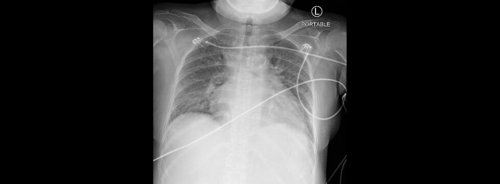 A photo of plain radiograph on dark background in hospital. The film use for diagnosis the illness of patient.Medical concept.A film chest of patient with corona virus infection with sever pneumonia. 