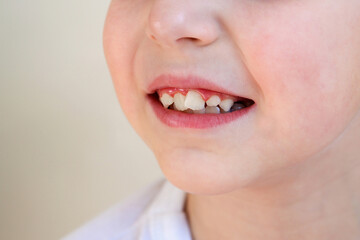 Child has crooked teeth. The concept of crowding of molars.