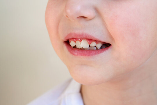Child has crooked teeth. The concept of crowding of molars.