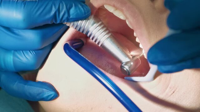 Close up footage of dentist drilling tooth and preparing for dental filling.