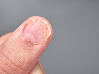 Brittle fingernail of a 9 year old boy close up look, isolated on gray background, with copy space