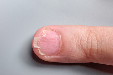 Brittle fingernail of a 9 year old boy close up look, isolated on gray background - obrazy, fototapety, plakaty