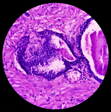 Prostate Cancer(TURP): Microscopic image of prostatic tissue, adenocarcinoma, malignant neoplasm,atypical epithelial cells, malignant tumor
