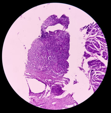 Prostate Cancer: Photomicrograph of biopsy of prostate gland showing histology of adenocarcinoma, prostatic tissue, nodular prostatic hyperplasia, malignant neoplasm,atypical epithelial cells.