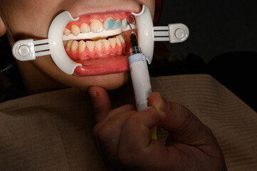 Plastic retractor for lip augmentation in the mouth, dental procedure and retractor as an auxiliary...