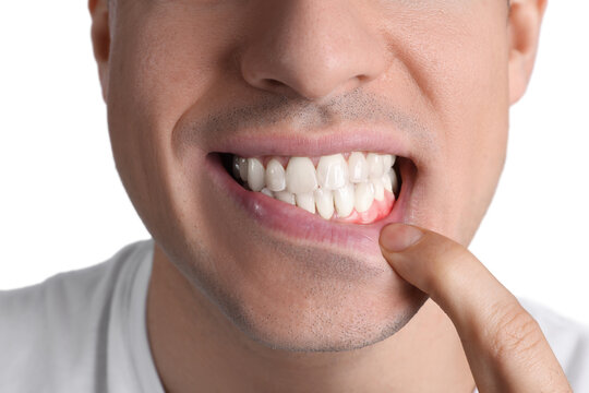 Man showing inflamed gums on white background, closeup