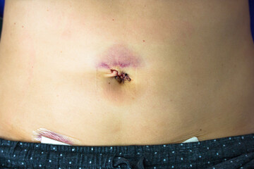 Woman's abdomen fresh medical scars after laparoscopy surgery, remove gallbladder, ovary, uterus,...