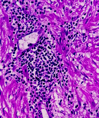 Prostate Cancer (TURP): Microscopic image of prostatic tissue, adenocarcinoma, malignant neoplasm, atypical epithelial cells, malignant tumor. transurethral resection of the prostate.