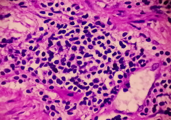 Prostate Cancer (TURP): Microscopic image of prostatic tissue, adenocarcinoma, malignant neoplasm,...