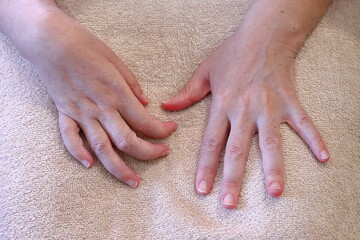 The hands of a woman who has had 4 strokes. Her right hand is paralyzed.