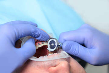 Installing braces. A man installs braces in a dental clinic. Separation in dentistry. Removal of a part of the enamel. Modern dentistry.