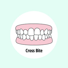 Cross Bite. Dental problem vector illustration. Dental care concept.
