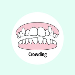 Crowding. Dental problem vector illustration. Dental care concept.