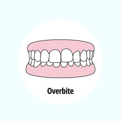 Overbite. Dental problem vector illustration. Dental care concept.