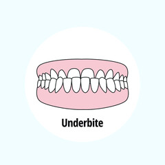 Obraz premium Underbite. Dental problem vector illustration. Dental care concept.