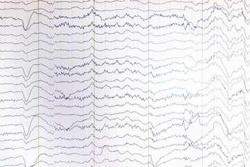 Electroencephalogram showing rhythm of brain activity