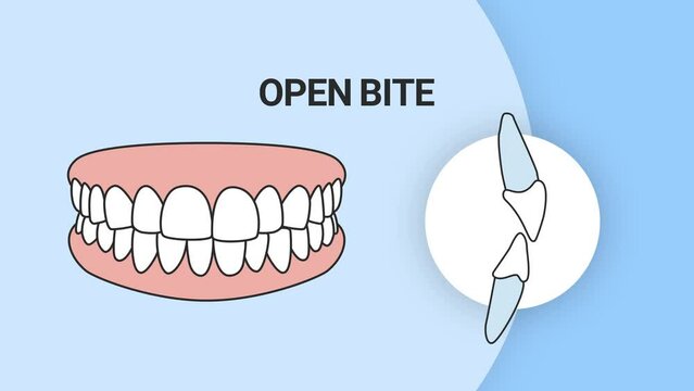 Malocclusion Open Bite. Dental problem. 3d illustration. Dental care concept.
