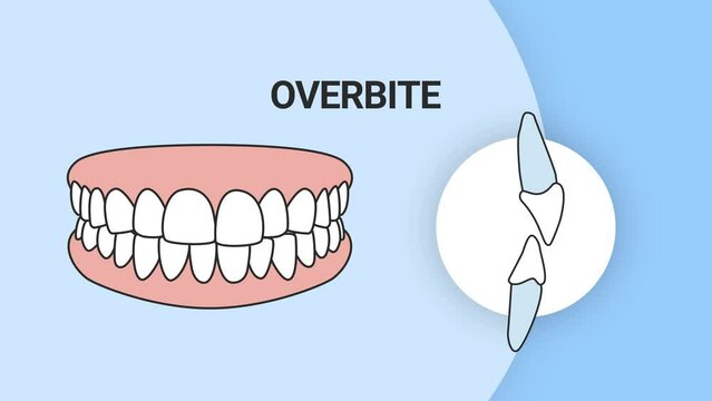 Malocclusion Overbite. Dental problem. 3d illustration. Dental care concept.