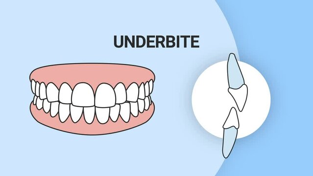 Malocclusion underbite. Dental problem. 3d illustration. Dental care concept.