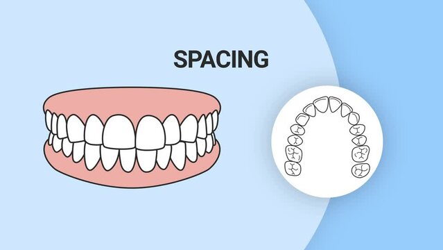 Malocclusion spacing. Dental problem. 3d illustration. Dental care concept.