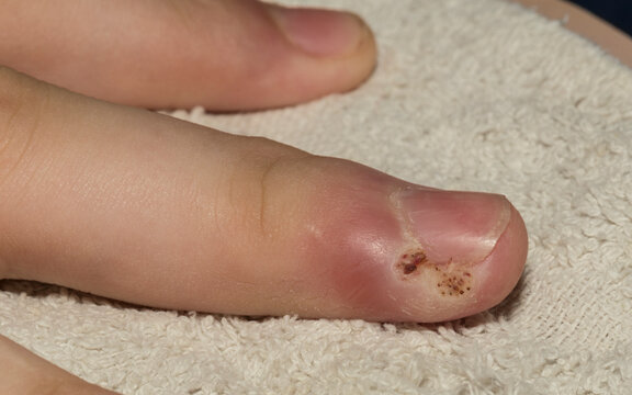 Whitlow or felon is an infection of the tip of the finger.
