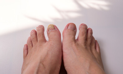 toenail fungus 02 - is comparing two toenail, one is good and the other one got infected.