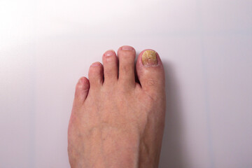 toenail fungus - toenail infection.
