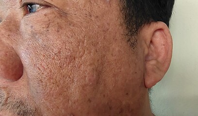 Obraz premium close up portrait the Inflammation skin of Middle-aged man, showing pimple and blackhead on the face, concept health care.