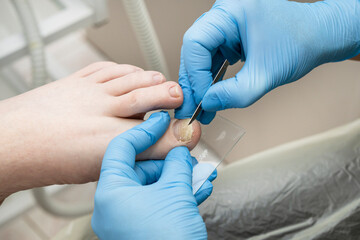 Analysis of the problem nail scraping of the female nail for further diagnosis.