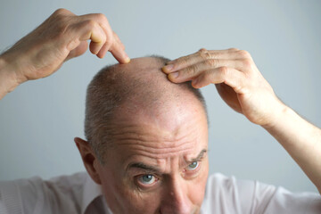 close-up old bald charismatic mature man showing his hair fall from head, patient with alopecia in...