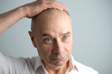 close-up old bald charismatic mature man showing his hair fall from head, patient with alopecia in hair growth clinic, topic of hair loss in men, selective focus. Anti-aging treatments for balding men