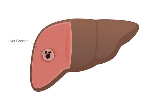 Cancer spreads to the human liver that develops be a tumor. medical diagram about Cancer metastasis.