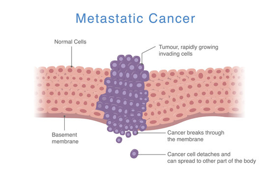 Cancer spreads from one part of the body to other parts. Medical diagram about Process of Metastatic cancer that develops to the tumor.