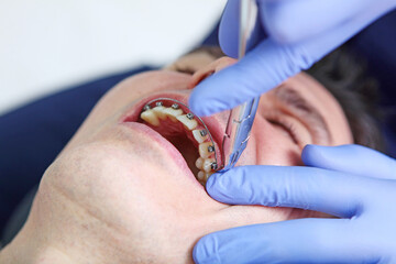 Adjustment of braces during wearing. Braces on the teeth. A man at an orthodontist's appointment. Open mouth. Modern dentistry. A photo in a real clinic. Close-up.