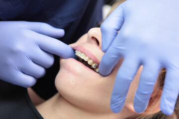 Ceramic braces. Two types of braces on the upper teeth. A woman at an orthodontist's appointment. Bite correction and tooth growth. Adjustment of braces during wearing. Open mouth. Modern dentistry.