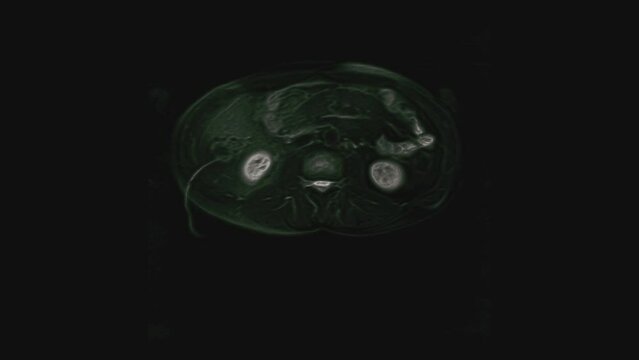 Voluminous color CT scan of the abdomen. Computed tomography of the gastrointestinal tract, liver and kidneys
