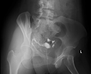 x-ray image of  Normal Hysterosalpingography (HSG) 

