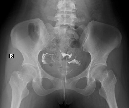 x-ray image of  Normal Hysterosalpingography (HSG) 
