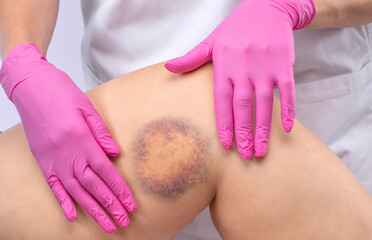 Large bruise on the patient's leg. The doctor examines the leg and smears the ointment. - obrazy, fototapety, plakaty