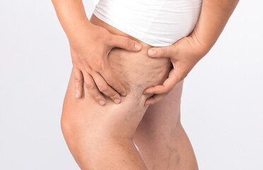 A man shows cellulite on his legs, the concept of weight loss and a healthy lifestyle.